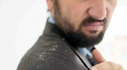 Ketombe ( Dandruff )