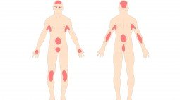 Psoriasis, Penebalan Kulit yang Membuat Malu.